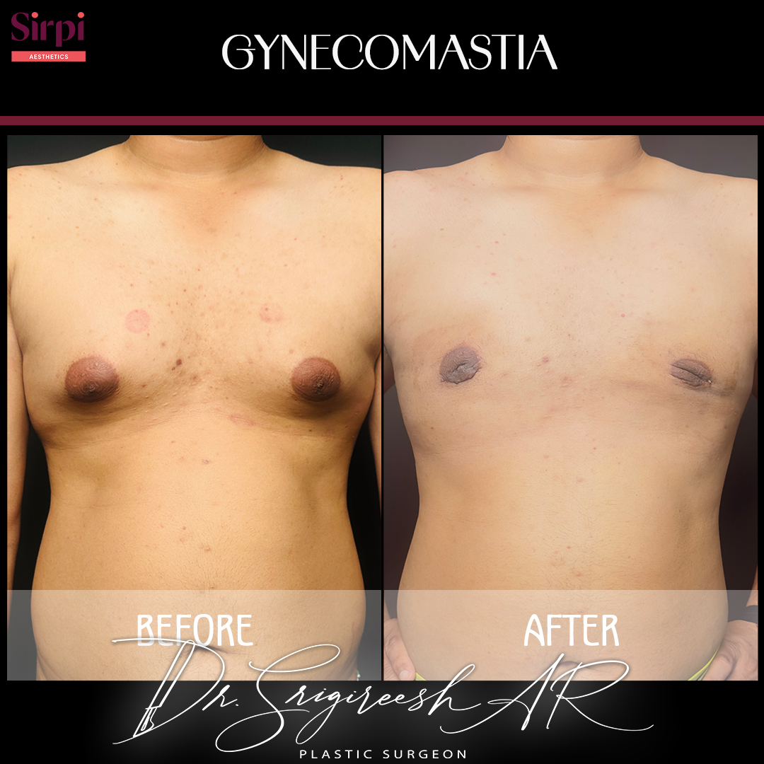 Gynecomastia before and after comparison 1