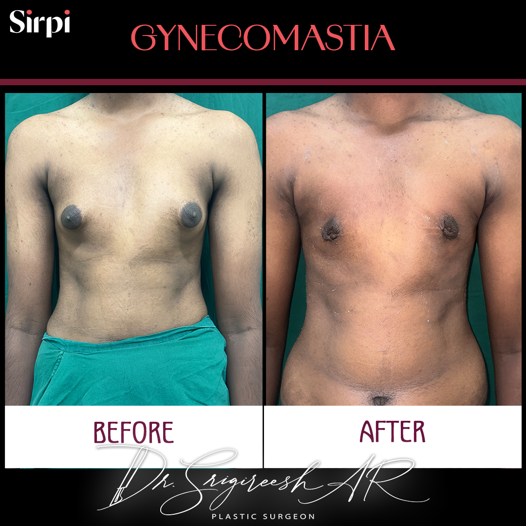 Gynecomastia before and after comparison 2