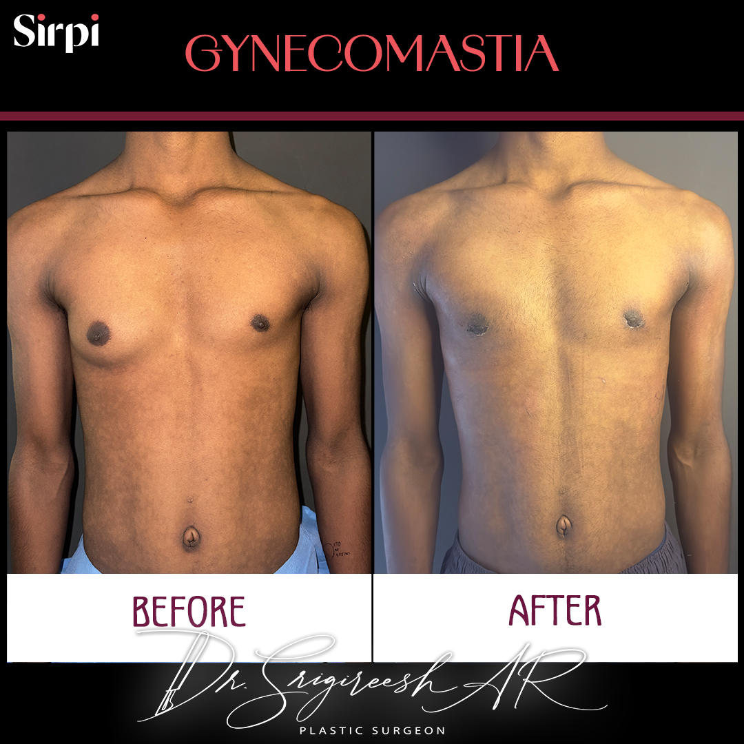 Gynecomastia before and after comparison 3