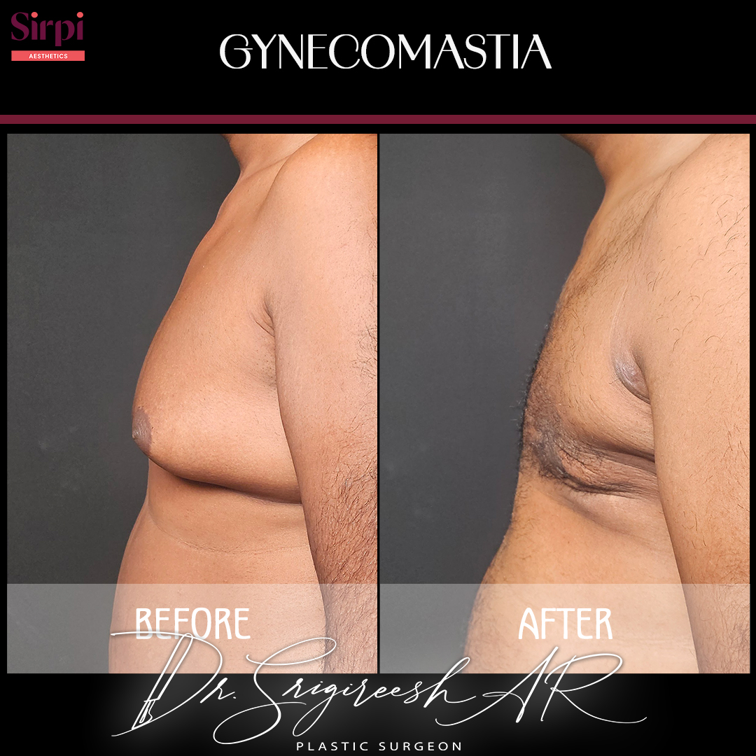 Gynecomastia before and after comparison 4