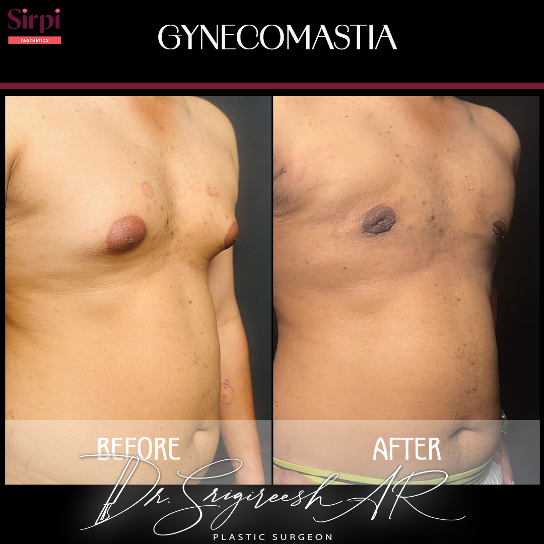 Gynecomastia before and after comparison 5