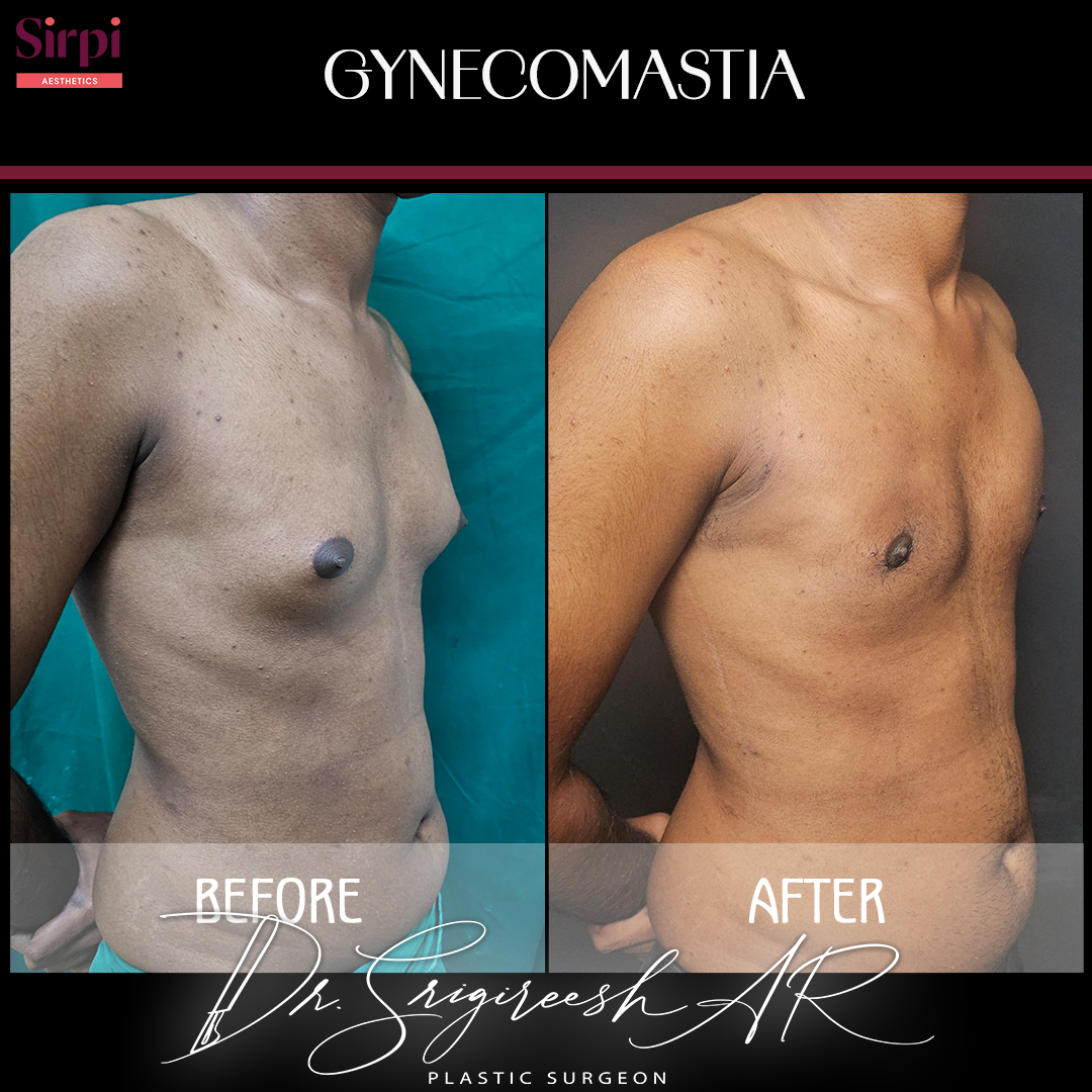 Gynecomastia before and after comparison 6