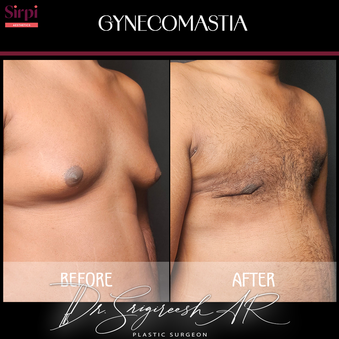 Gynecomastia before and after comparison 7